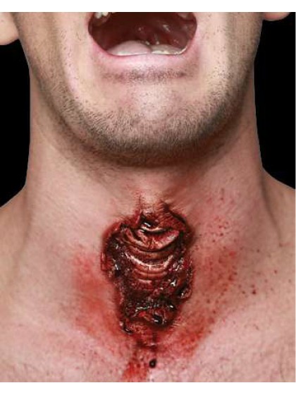 APPLIANCE - TRAQUEOTOMY 