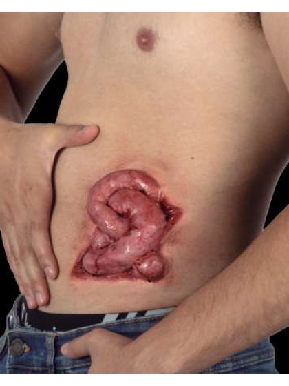 CICATRICE LATEX BLESSURE INTESTIN 